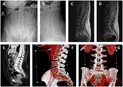 Case Report: A Rare Case of <mark class="highlighted">Fourth Ventricle</mark> to Spinal Subarachnoid Space Shunt Migration: Surgical Pearl and Literature Review